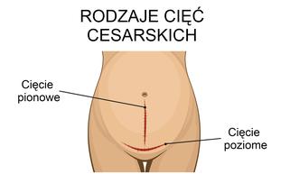 Rodzaje cięć cesarskich