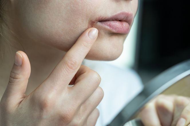 Domowe sposoby na opryszczkę - sposób na opryszczkę w 1 dzień